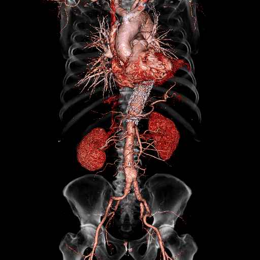 大血管の3D（胸部大動脈グラフト）.jpg