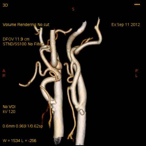 頚部の血管の3D.jpg